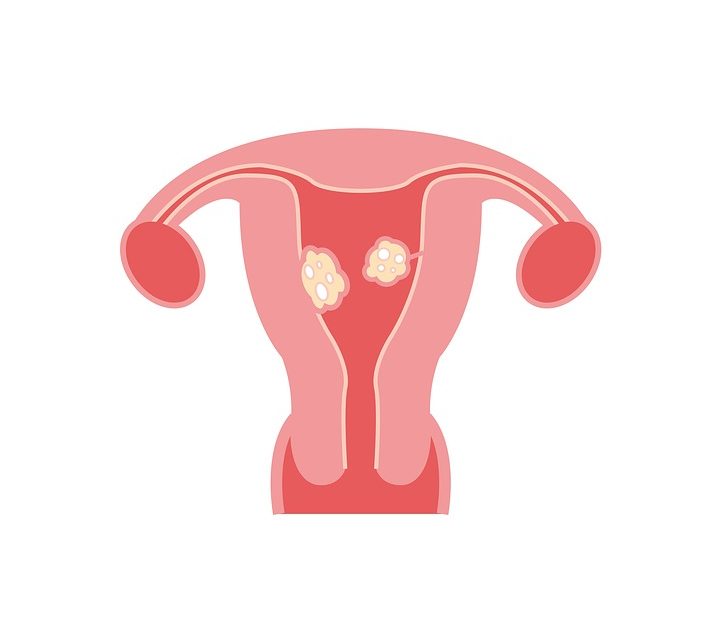 Quelles sont les solutions disponibles pour remédier aux fibromes utérins?